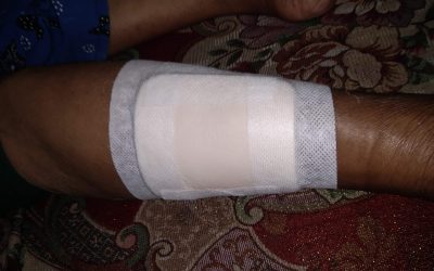 REVIEW JURNAL: EFEKTIVITAS MODERN DRESSING PADA MANAJEMEN PERAWATAN LUKA KRONIS
