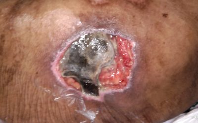 Memahami Pressure Injury: Patofisiologi, Tata Laksana, dan Strategi Pencegahan Berbasis Bukti
