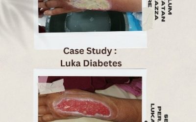 Moist Wound Healing: Paradigma Modern dalam Perawatan Luka