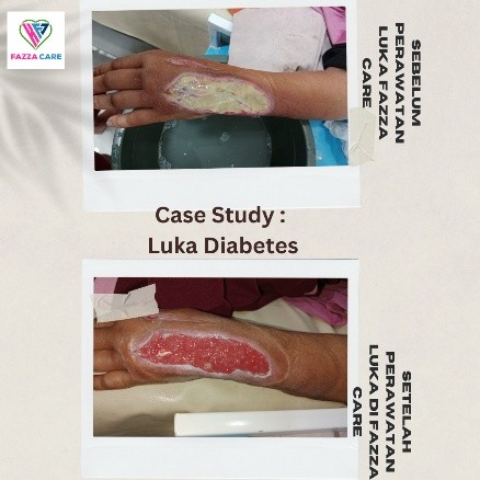 Moist Wound Healing: Paradigma Modern dalam Perawatan Luka