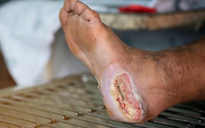Bahaya Luka Diabetes: Ancaman Serius yang Dapat Berujung Amputasi dan Kematian